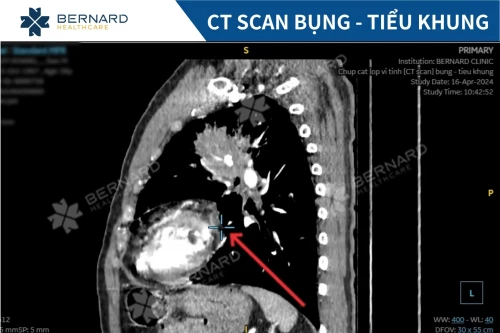 Chụp CT scan bụng - tiểu khung